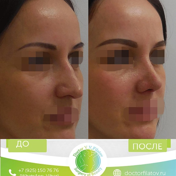 Ринопластика скидки. Реновация и коррекция носа в тольятти. Фото носа после операции по восстановлению носового дыхания. Операция носа в спб. Операция носа в спб.