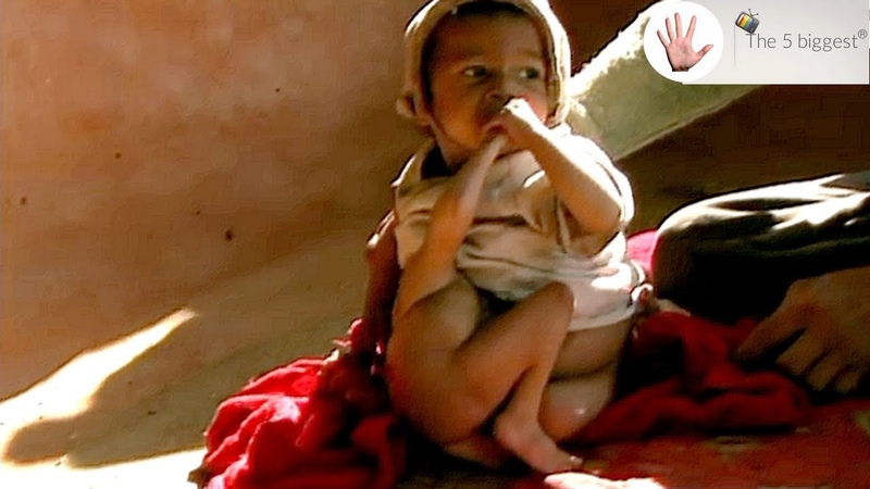 Most Rare Birth Condition: The Boy With 4 Arms and 4 Legs Whos Worshiped Body