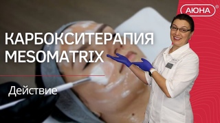 Как действует Карбокситерапия MESOMATRIX