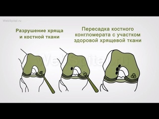 Диагностика и лечение артроза.  Пересадка костно хрящевого конгломерата
