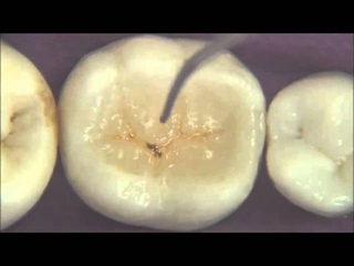 Procedimento de restauração estética em resina para dentes posteriores por Prof. Dr. Ronaldo Hirata