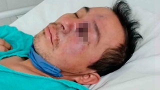 Черная плесень добралась в Мексику. Опасное заболевание вызвало эпидемию в Индии